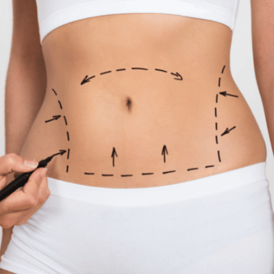 doctor drawing liposuction lines for surgery on slim female stomach