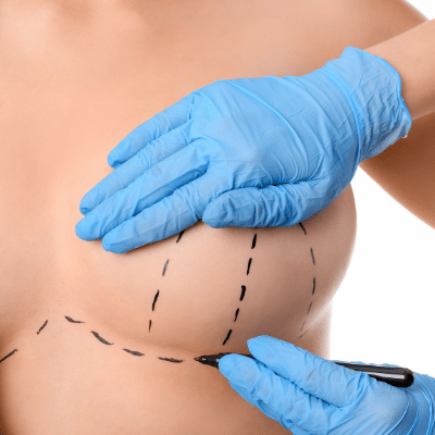 doctor in latex gloves drawing on model lines for plastic surgery