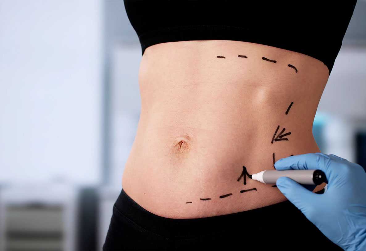 patient receiving an abdominoplasty in Newport News, VA