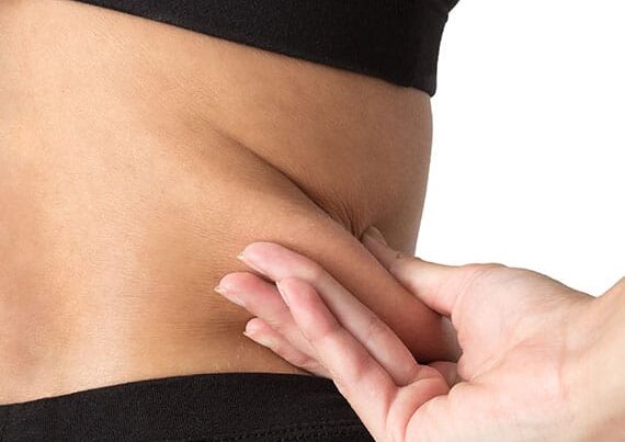 woman grabbing her excess skin before her excess skin removal surgery in Newport News, VA