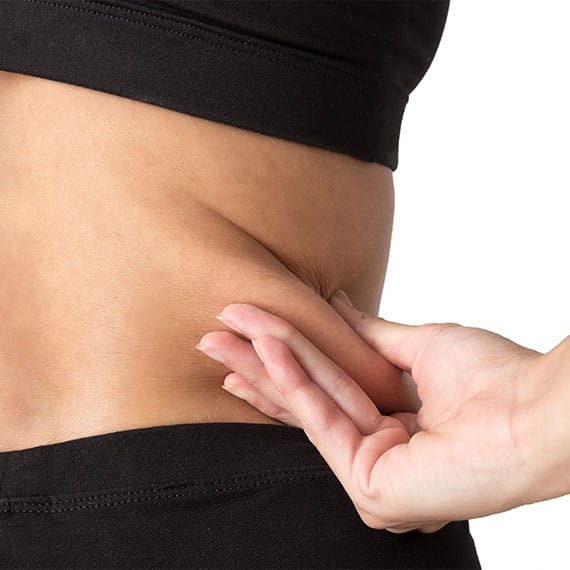 woman grabbing her excess skin before her excess skin removal surgery in Newport News, VA