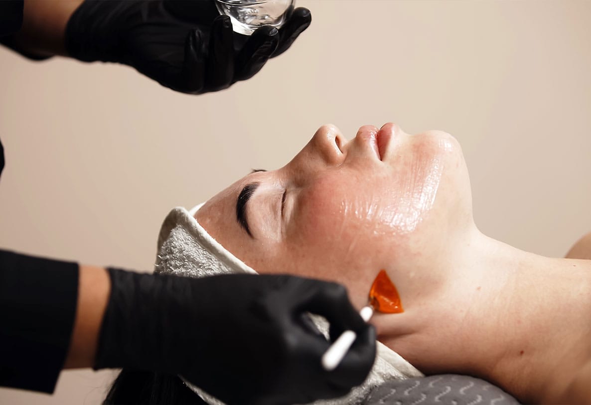 woman getting a chemical peel in Newport News, VA