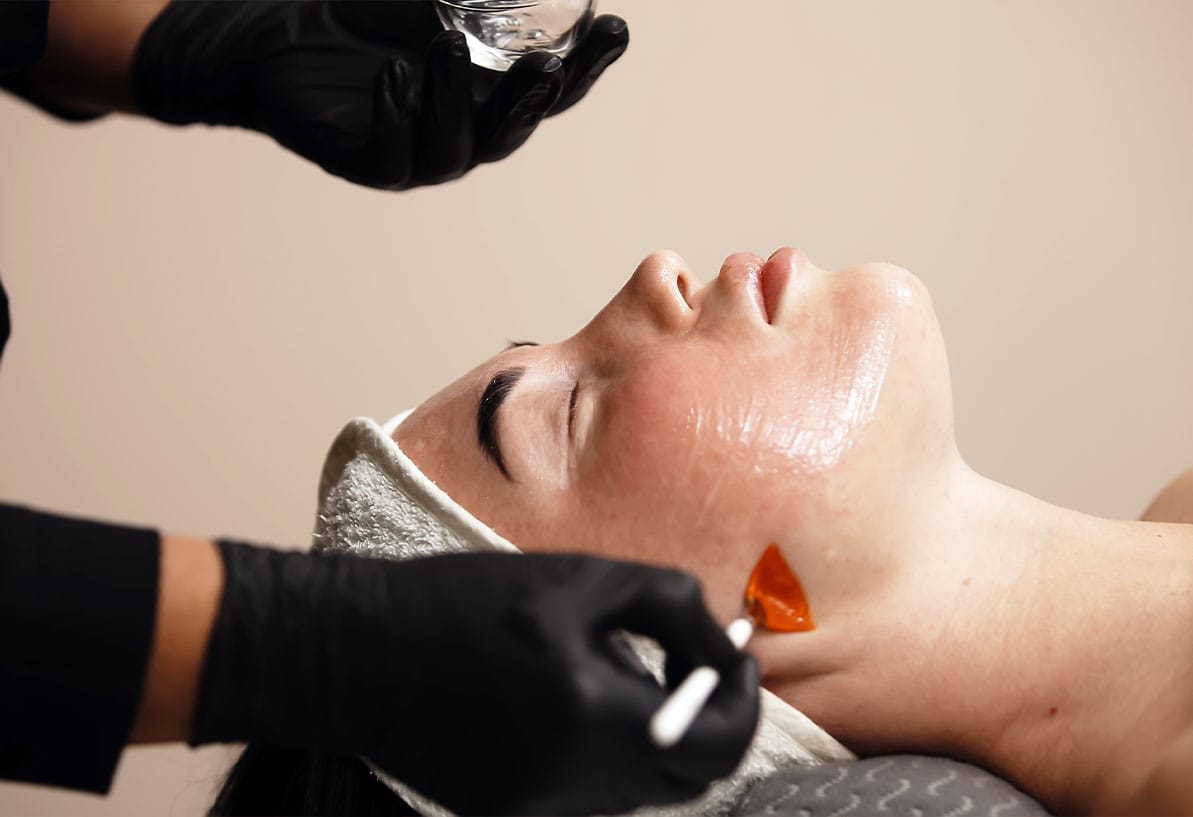 woman getting a chemical peel treatment at a medspa in Williamsburg, VA